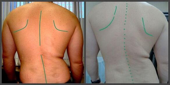 Craumatic της σπονδυλικής στήλης με οστεοχονδρία