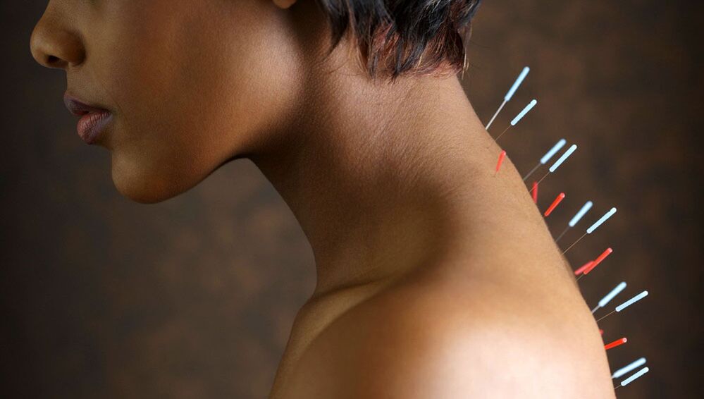 Βελονισμός με αυχενική οστεοχονδρία