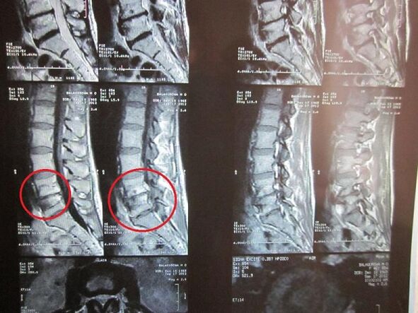 Διάγνωση της αυχενικής οστεοχονδρισμού