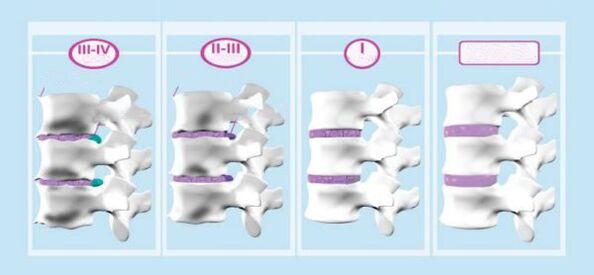 Στάδια της αυχενικής οστεοχονδρισμού