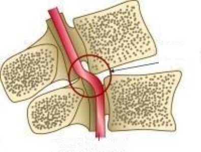 Σύνδρομο αρτηριών Vail