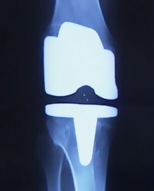 X -Ρύθμιση εικόνας του γόνατος με τεχνητή πρόθεση μετά την επιχείρηση για να αλλάξει την άρθρωση