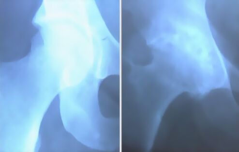 Αφρός αρθρίτιδας της άρθρωσης του γόνατος