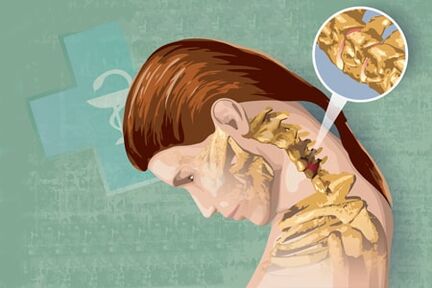 Αντανακλαστικά συμπτώματα οστεοχονδρισμού